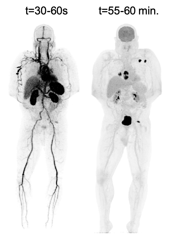 First Total Body Dynamic Pet Scan Of A Cancer Patient Completed Wang Lab Pet